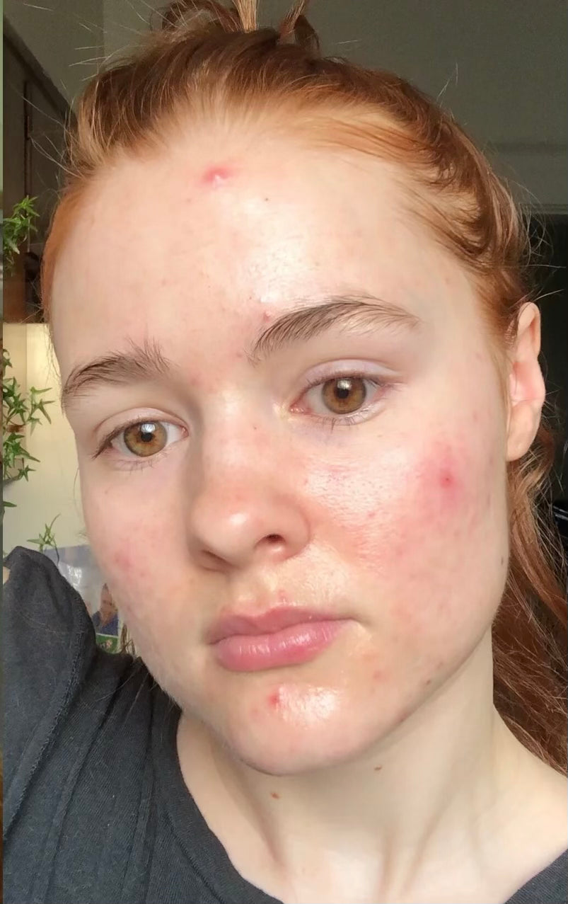 woman with acne before dimo silk 